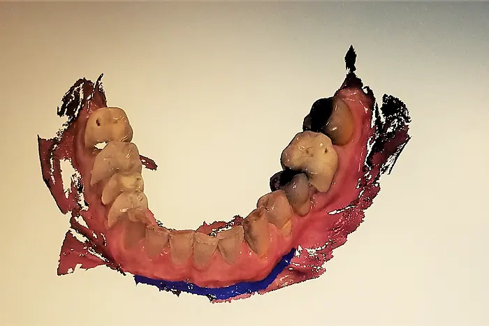 An intraoral scan of a lower arch on screen